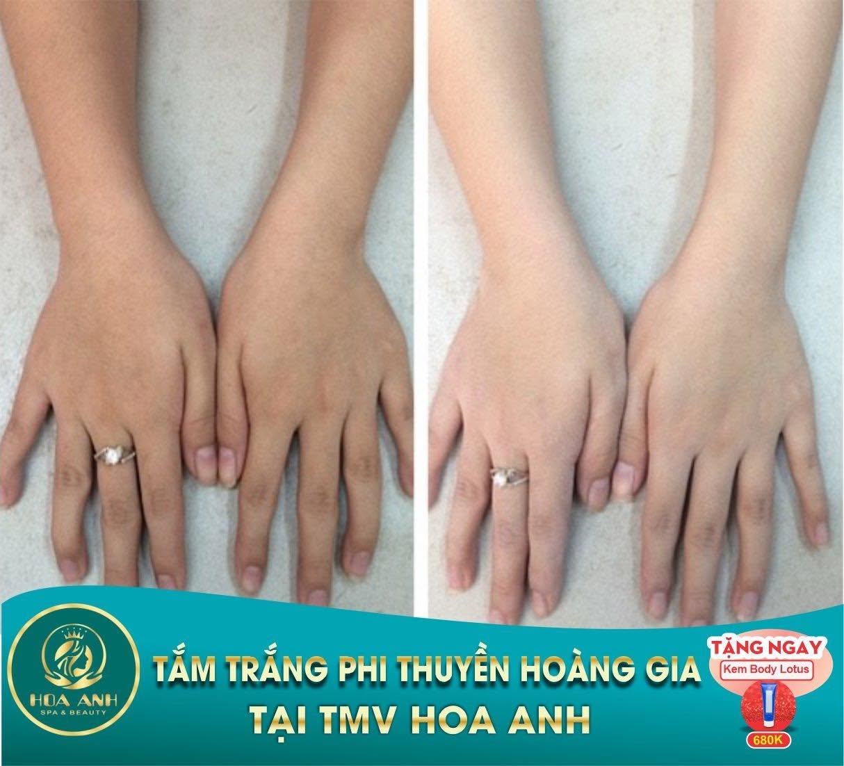 Trước và sau tắm trắng Phi Thuyền Hoàng Gia vùng tay tại Hoa Anh